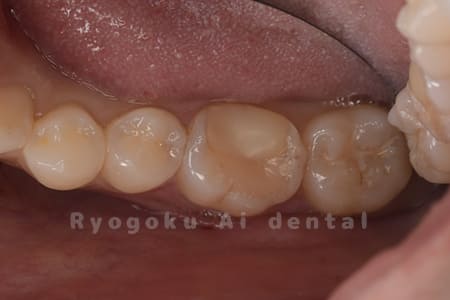 他院で治療終了となり、しみる症状がある