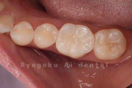 ジルコニアクラウン