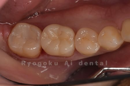 セラミッククラウン