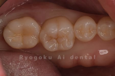 セラミックインレー