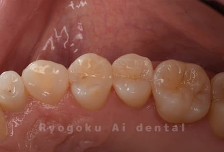 セラミックインレー、ダイレクトボンディング