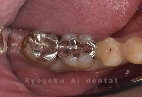 インレー2次カリエス、ならびにインレー脱離