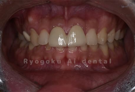 前歯部補綴不適合