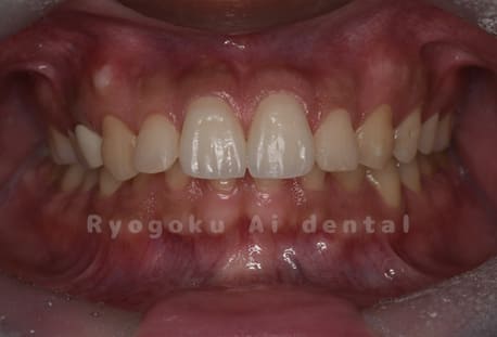 ジルコニアセラミッククラウンでの再補綴治療