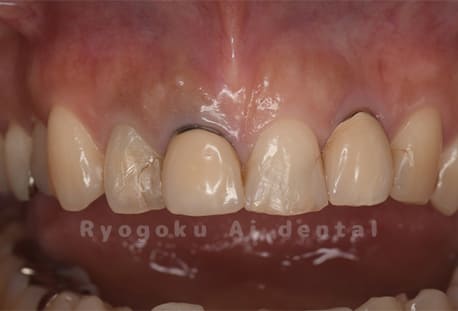 前歯部不良補綴