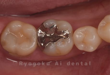 インレー不適合