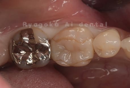 インレー不適合