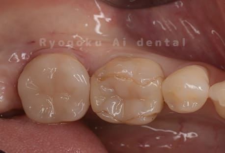 セラミッククラウンでの再治療