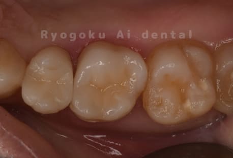 セラミッククラウンでの再治療