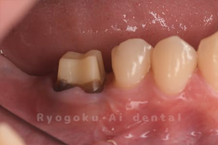 クラウンレングスニング