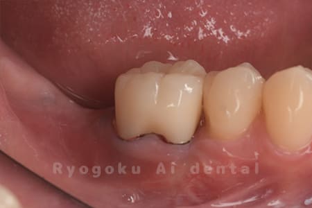 ジルコニアクラウン