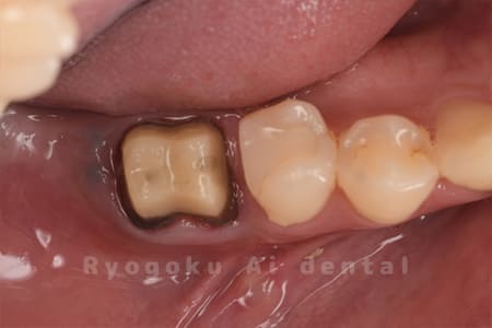 クラウンレングスニング