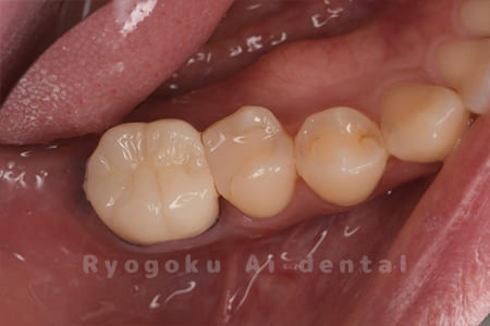 ジルコニアクラウン