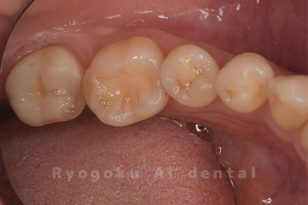 インレー不適合