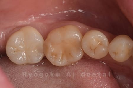 セラミッククラウンでの再治療
