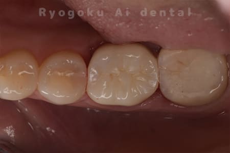 ジルコニアクラウン装着