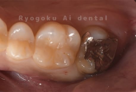 インレー2次カリエス