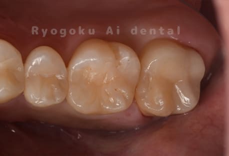 左上６番→ダイレクトボンディング、左上７番→セラミックインレー