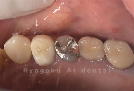 インレー2次カリエス