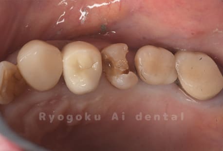 インレー2次カリエス除去