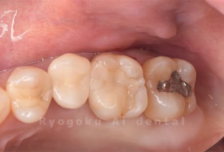 左上6番セラミックインレー2次カリス、左上7番インレー2次カリス