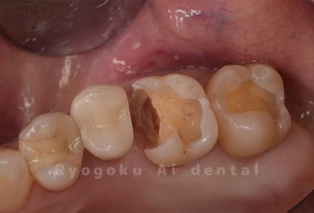 インレー2次カリエス除去
