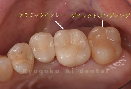 26セラミックインレー、27ダイレクトボンディング修復