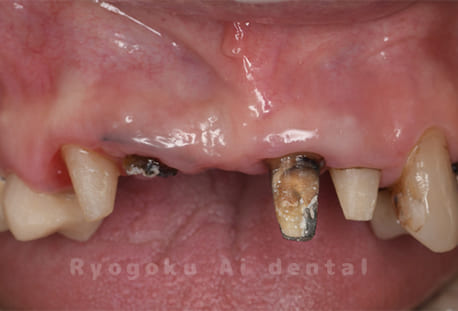 クラウンレングスニング術前