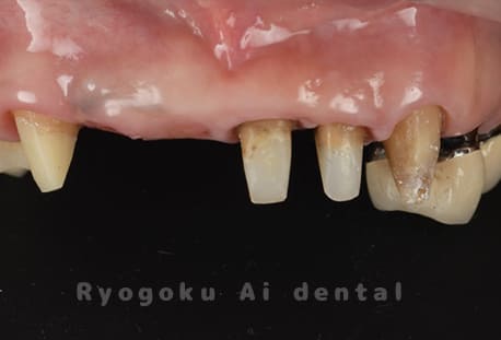 クラウンレングスニング術後