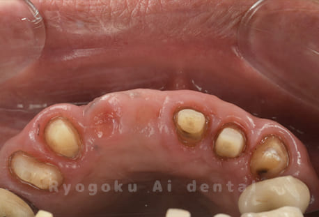 クラウンレングスニング術後