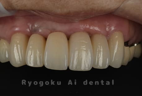 クラウンレングスニング、ポンティックシールド、セラミッククラウン修復術後