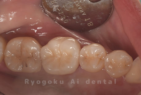 セラミッククラウン