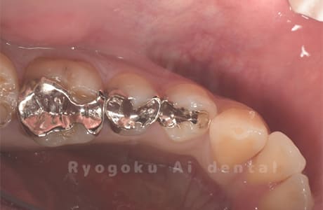 インレー2次カリエス