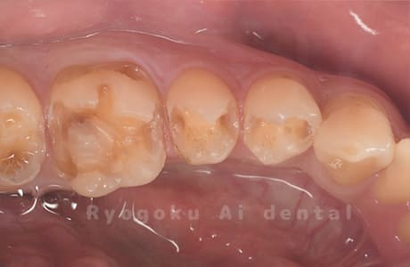 インレー2次カリエス除去