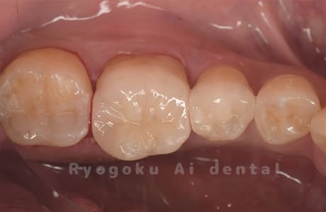 セラミックインレー修復、ダイレクトボンディング