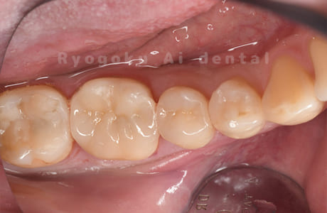セラミックインレー修復、ダイレクトボンディング