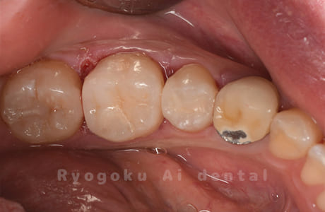 セラミックインレー修復