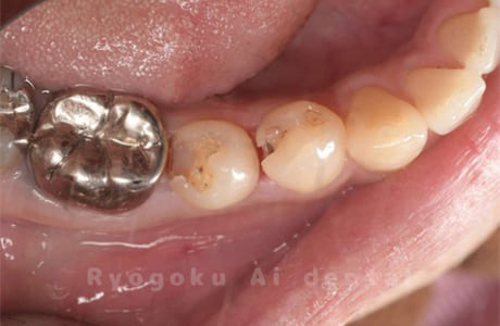 44・45重度カリエス