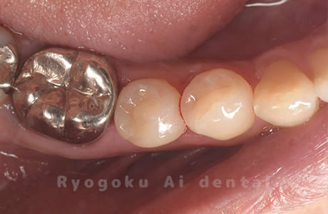 セラミックインレー治療