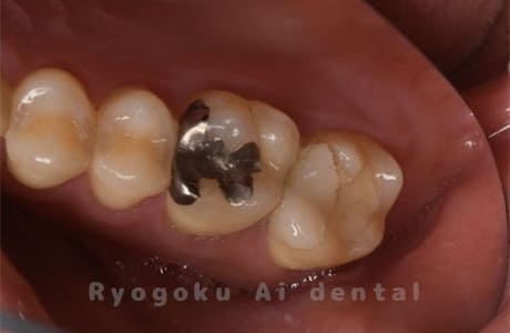 17セラミックインレー破折