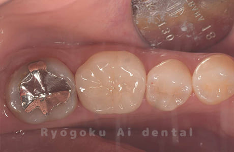 セラミッククラウン治療