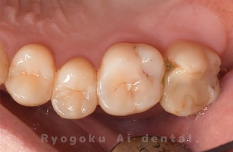 左上７番セラミック破折