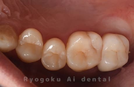 ジルコニアクラウン