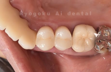 クラウンレングスニング、ジルコニアクラウン