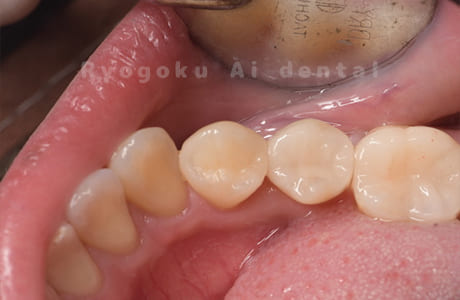 セラミックインレー修復