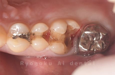 補綴物二次カリエス