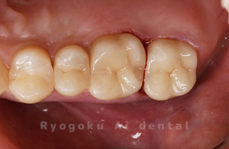24番ダイレクトボンディング、25番セラミックインレー修復、26・27番セラミッククラウン修復