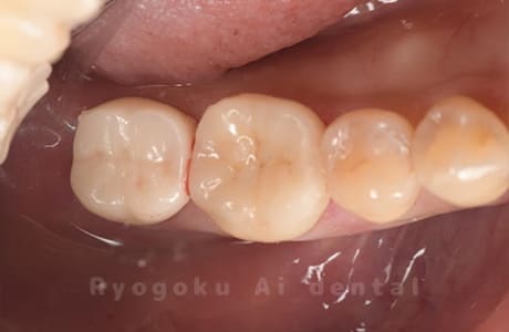 セラミッククラウン修復