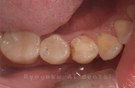 セラミックインレー破折