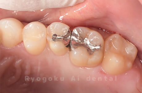 銀歯を白くしたい